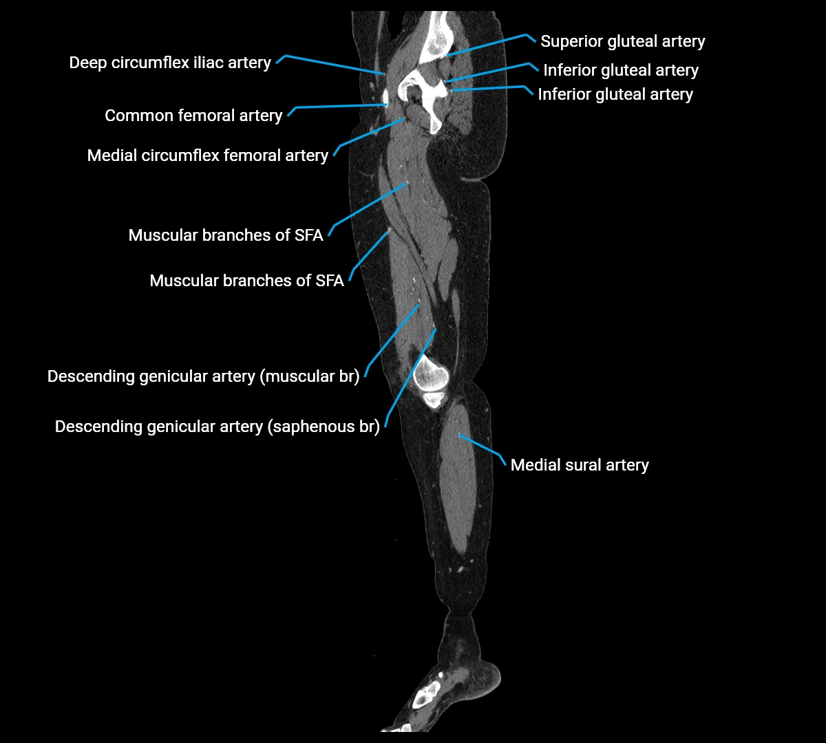 CTA lower limb sagittal cross sectional anatomy labelled image _27 (4).webp